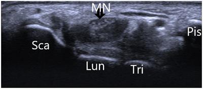 B-Mode ultrasound imaging in diagnosing carpal tunnel syndrome: an auxiliary diagnostic tool for hand surgeons